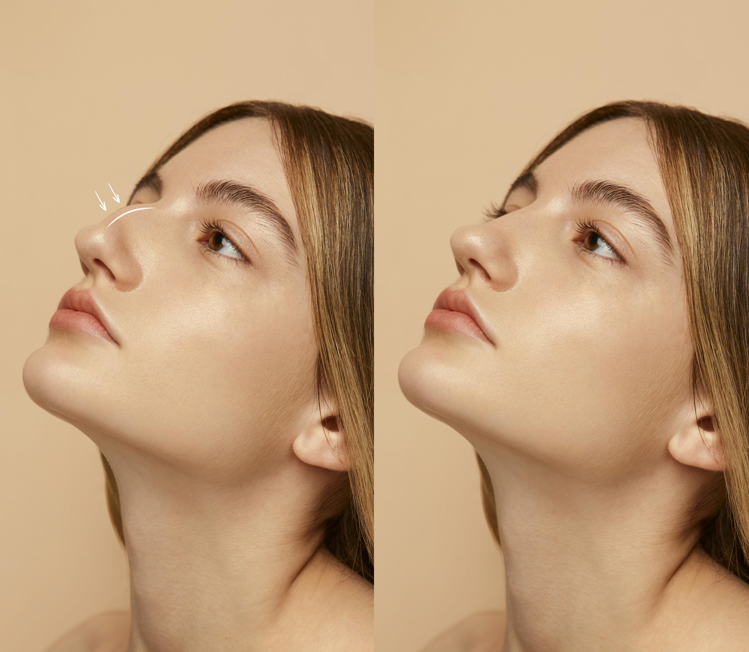 rhinoplasty
